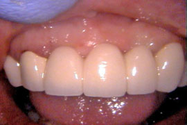 Front teeth bridges - after