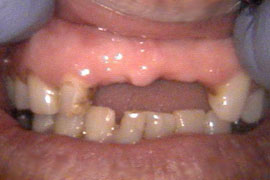 Front teeth bridges - before