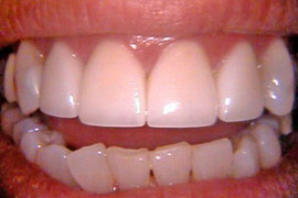 Cosmetic crowns - after