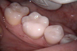 Fillings and CEREC - After