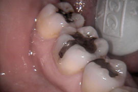 Fillings and CEREC - Before