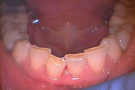Bottom teeth cosmetic crowns - before